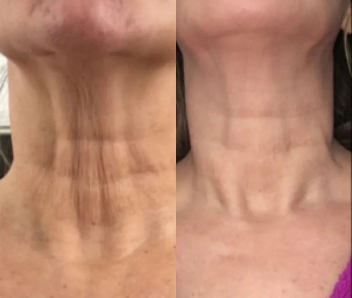Lunalleskin 3-in-1 Led Facial Sculptor
